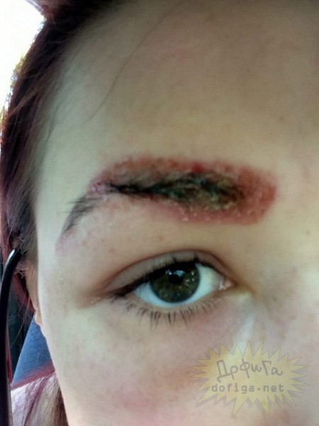 Êàê îêàçàëîñü, HD-îêðàøèâàíèå áðîâåé âûçâàëî ñèëüíóþ àëëåðãè÷åñêóþ ðåàêöèþ, îæîãè è îòåê ëèöà. Ñåé÷àñ äåâóøêà âûíóæäåíà íå ïîÿâëÿòüñÿ íà ëþäÿõ è ïðèíèìàòü ñèëüíåéøèå àíòèáèîòèêè è àíòèãèñòàìèííûå ïðåïàðàòû.