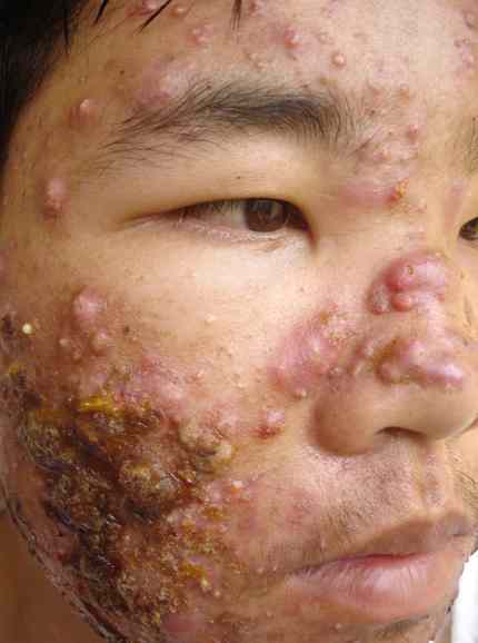 pimple-rash-in-infants-treatment-best-medications-sdt