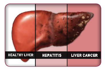 liver_cancer (1)