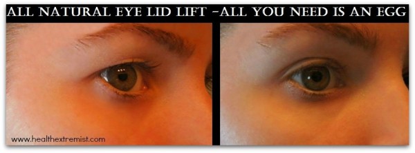 natural-remedy-drooping-eyelids1