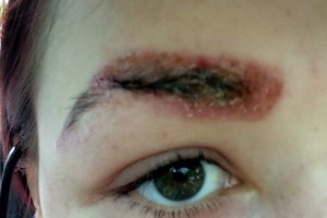 Êàê îêàçàëîñü, HD-îêðàøèâàíèå áðîâåé âûçâàëî ñèëüíóþ àëëåðãè÷åñêóþ ðåàêöèþ, îæîãè è îòåê ëèöà. Ñåé÷àñ äåâóøêà âûíóæäåíà íå ïîÿâëÿòüñÿ íà ëþäÿõ è ïðèíèìàòü ñèëüíåéøèå àíòèáèîòèêè è àíòèãèñòàìèííûå ïðåïàðàòû.