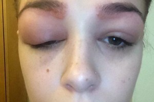 Äåâóøêà ñêàçàëà, ÷òî ñåé÷àñ å¸ áðîâè íà÷àëè àêòèâíî ïîêèäàòü å¸ ëèöî è âìåñòî êðàñèâûõ áðîâåé, îíà ïîëó÷èëà ñòðàøíóþ àëëåðãè÷åñêóþ ðåàêöèþ