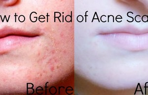 best-acne-treatment-home-remedies-severe-acne-org-scars-w1s