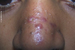 whey-protein-concentrate-cause-acne-rash-eyebrows-forehead-between-krg