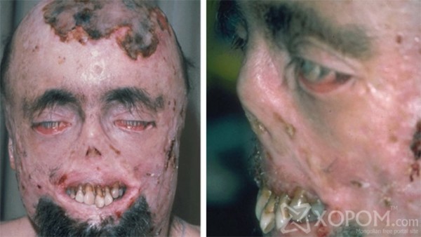 XopoM.com-Итгэхийн-аргагүй-аймшигтай-ховор-өвчнүүд-03 (1)